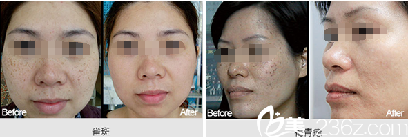 南充韩美整形美容医院祛斑案例