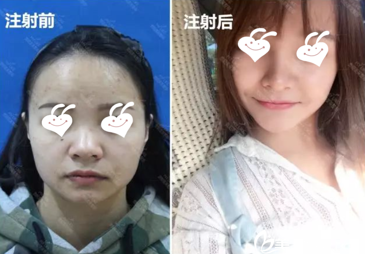 钱刚注射玻尿酸丰下巴效果 钱刚注射玻尿酸丰下巴效果