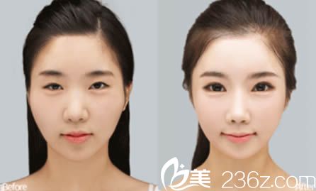 韩美陈诚面部综合整形效果图示 韩美陈诚面部综合整形效果图示
