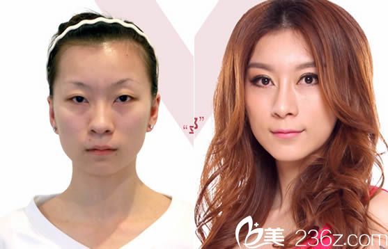 韩美<!--<i data=20240703-sp></i>-->整形效果图示 韩美<!--<i data=20240703-sp></i>-->整形效果图示