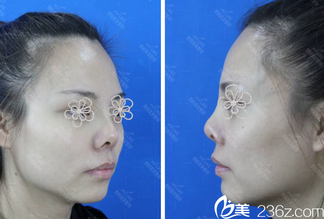 贵阳美莱医疗美容医院朝天鼻手术案例 贵阳美莱医疗美容医院朝天鼻手术案例
