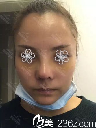 术后第九天了 术后第九天了