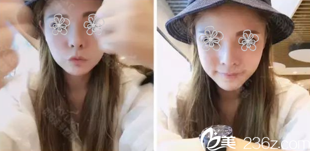 术后34天了,心情很棒! 术后34天了,心情很棒!