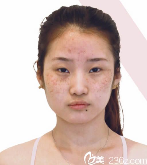 兰州韩美整形祛斑前图片 兰州韩美整形祛斑前图片