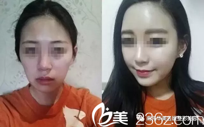 南充华美祛黑眼圈+脂肪填充全面部术后对比照 南充华美祛黑眼圈+脂肪填充全面部术后对比照