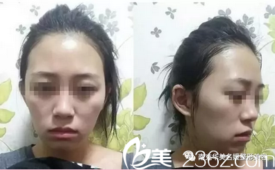自体脂肪去除黑眼圈+脂肪填充全面部术前照 自体脂肪去除黑眼圈+脂肪填充全面部术前照