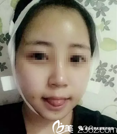 南充华美自体脂肪填充全面部术后5天 南充华美自体脂肪填充全面部术后5天