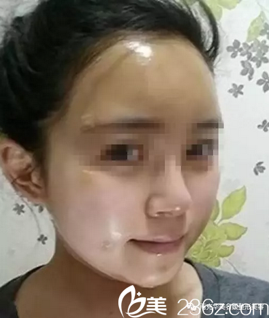 南充华美自体脂肪去除黑眼圈术后8天 南充华美自体脂肪去除黑眼圈术后8天