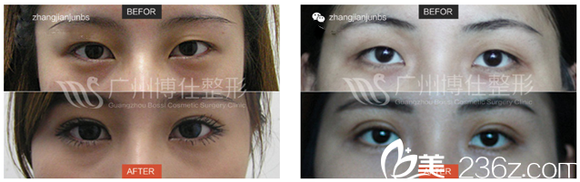广州博仕李帅敏医生做的仿生理双眼皮案例对比图