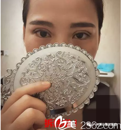 2双眼皮7天拆线效果