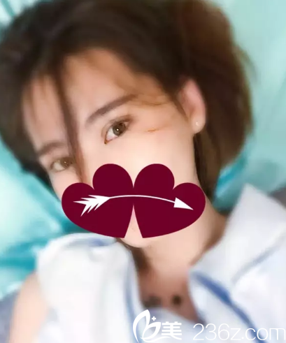 双眼皮术后1个月效果