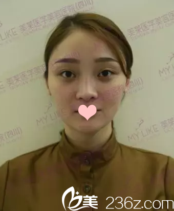 鼻修复术前照片 鼻修复术前照片