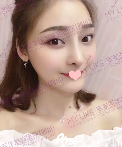 隆鼻术后1个月自拍 隆鼻术后1个月自拍