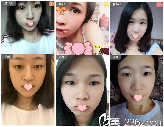 广州韩妃整形医院李光琴双眼皮效果图