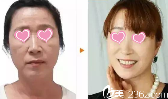 面部年轻化提升术后效果 面部年轻化提升术后效果