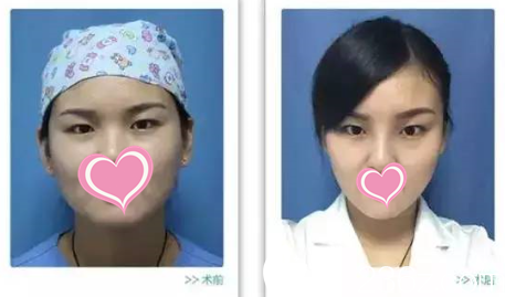 面部轮廓塑形术后 面部轮廓塑形术后