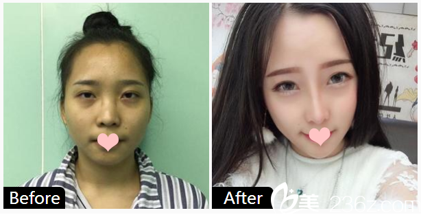 广州飞悦整形医生刘跃飞做的鼻综合隆鼻案例对比图