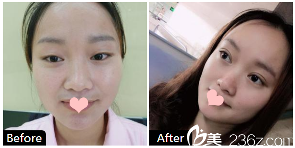 广州飞悦整形医疗美容医院刘海洋双眼皮案例