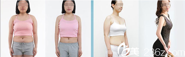 南充五星整形美容医院360水动力吸脂塑身案例 南充五星整形美容医院360水动力吸脂塑身案例