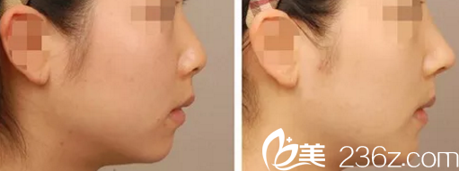 陈先才耳软骨隆鼻案例 陈先才耳软骨隆鼻案例