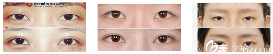 深圳博爱医院整形科双眼皮案例对比图