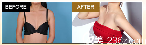 深圳<!--<i data=20240703-sp></i>-->整形科隆胸案例 深圳<!--<i data=20240703-sp></i>-->整形科隆胸案例