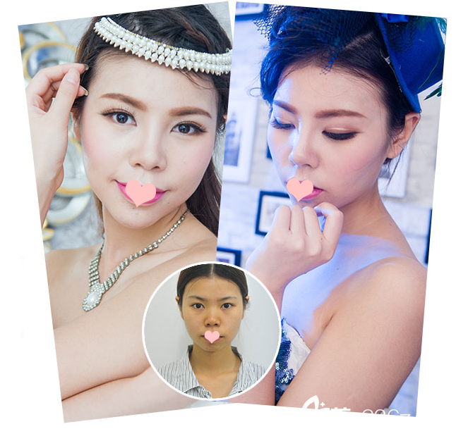 深圳<!--<i data=20240703-sp></i>-->整形科隆鼻案例展示 深圳<!--<i data=20240703-sp></i>-->整形科隆鼻案例展示