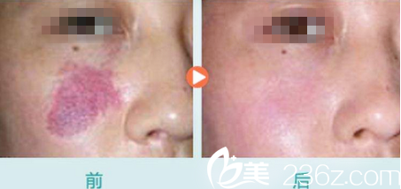 运城华美整形刘兴芳激光祛胎记 运城华美整形刘兴芳激光祛胎记