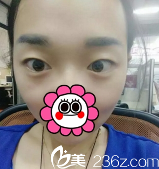 运城华美双眼皮术前 运城华美双眼皮术前