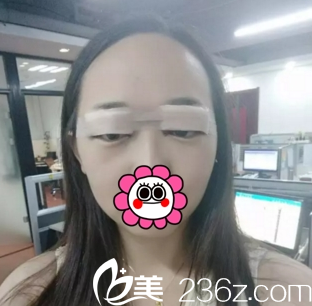 运城华美眼综合案例术后效果 运城华美眼综合案例术后效果