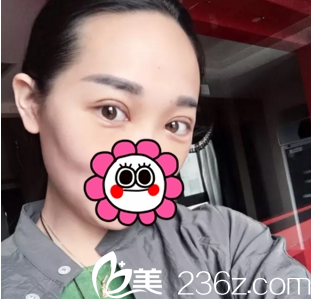 双眼皮案例术后10天运城华美 双眼皮案例术后10天运城华美