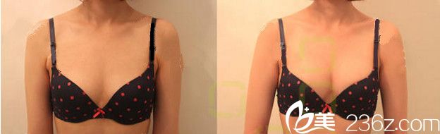 朴泰赫自体脂肪移植丰胸案例