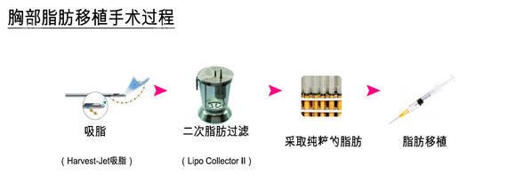 自体脂肪移植丰胸手术过程