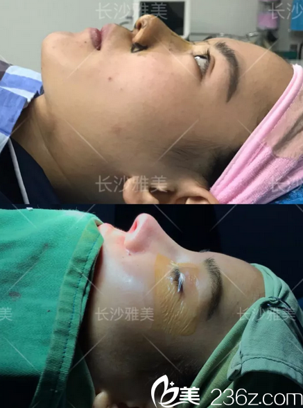 长沙雅美田芳斌鼻子真实案 例