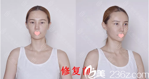 全切双眼皮失败照片 全切双眼皮失败照片