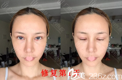 全切双眼皮修复天 全切双眼皮修复天