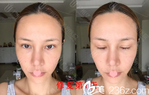做完全切双眼皮修复7天恢复情况 做完全切双眼皮修复7天恢复情况