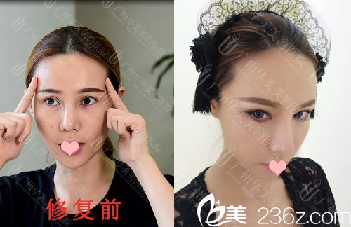双眼皮失败修复前后对比图 双眼皮失败修复前后对比图