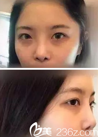 开眼角和隆鼻前的我 开眼角和隆鼻前的我