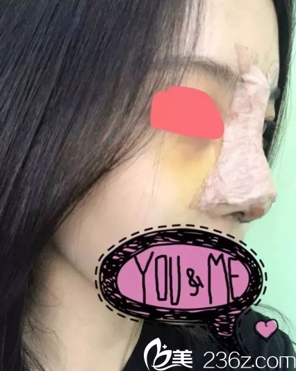 第三天,期待纱布拆掉后的样子 第三天,期待纱布拆掉后的样子