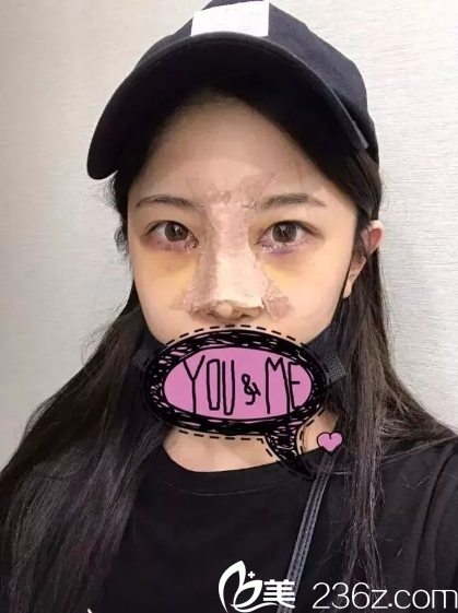 第五天,眼周有点发青 第五天,眼周有点发青