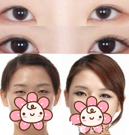 华美<!--<i data=20240703-sp></i>-->眼部整形效果