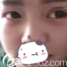 驻马店缔莱美双眼皮案例