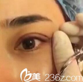 2980元我在驻马店缔莱美做的无痕双眼让我秒变电眼