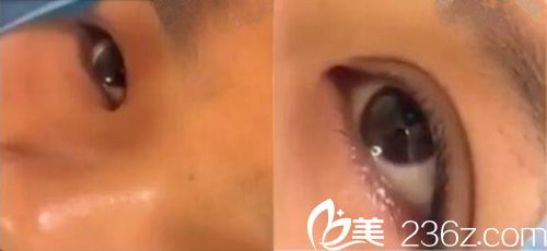 双眼皮手术中的照片