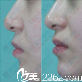 成都星美宝岛整形玻尿酸填充案例