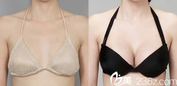 华美范志宏医生隆胸效果 华美范志宏医生隆胸效果