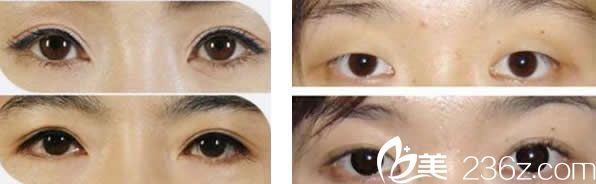 范志宏双眼皮整形前后 范志宏双眼皮整形前后