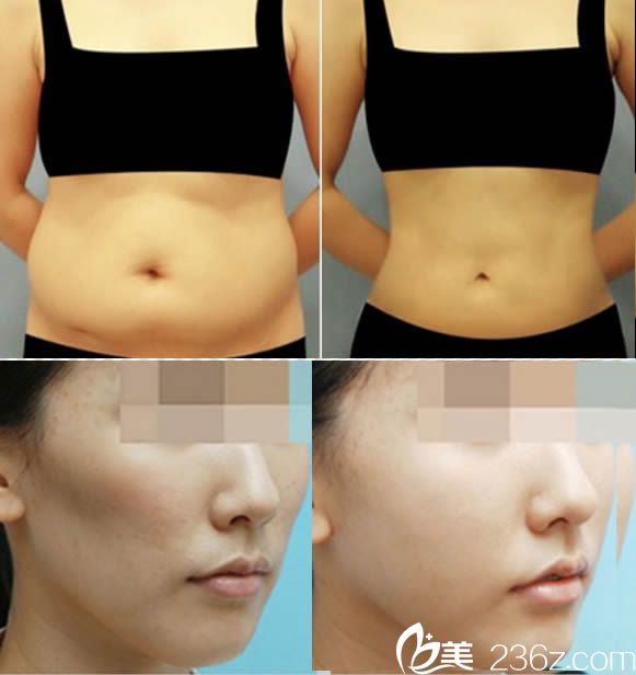 李东伟面部自体脂肪移植和腰腹吸脂案例