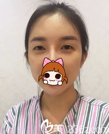 我的双眼皮加眼皮下垂矫正术前照 我的双眼皮加眼皮下垂矫正术前照